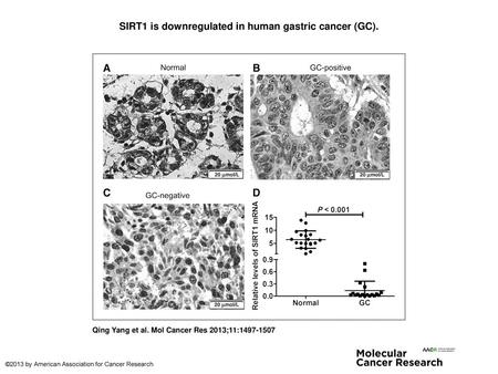 SIRT1 is downregulated in human gastric cancer (GC).