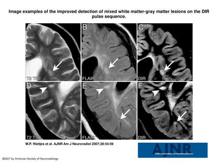 Image examples of the improved detection of mixed white matter-gray matter lesions on the DIR pulse sequence. Image examples of the improved detection.