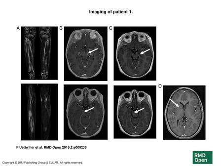 Imaging of patient 1. Imaging of patient 1. (A) Muscle MRI of both legs performed at the age of 5 years: coronal gadolinium-enhanced T1-weighted sequence.