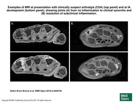 Examples of MRI at presentation with clinically suspect arthralgia (CSA) (top panel) and at IA development (bottom panel), showing joints (A) from no inflammation.