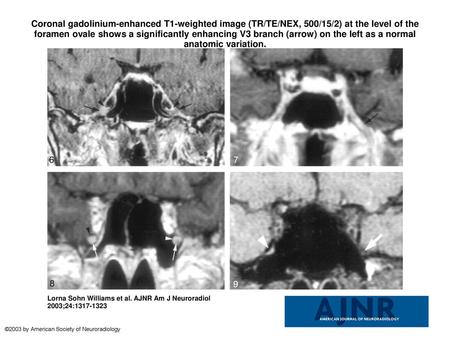 Coronal gadolinium-enhanced T1-weighted image (TR/TE/NEX, 500/15/2) at the level of the foramen ovale shows a significantly enhancing V3 branch (arrow)