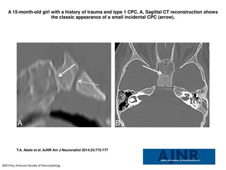 A 15-month-old girl with a history of trauma and type 1 CPC