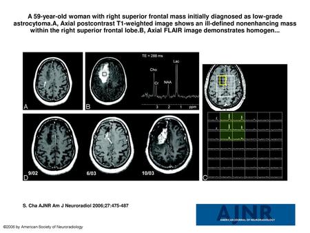 A 59-year-old woman with right superior frontal mass initially diagnosed as low-grade astrocytoma.A, Axial postcontrast T1-weighted image shows an ill-defined.