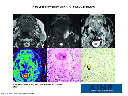 A 59-year-old womam with HPV− HNSCC (T2N0M0).