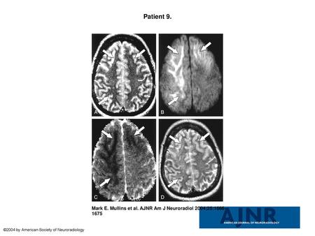 Patient 9. Patient 9. A 31-year-old man with mental status changes and seizure activity.A, T2-weighted axial MR image shows bilateral frontal and right.