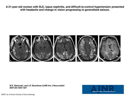 A 21-year-old woman with SLE, lupus nephritis, and difficult-to-control hypertension presented with headache and change in vision progressing to generalized.