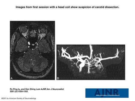 Images from first session with a head coil show suspicion of carotid dissection. Images from first session with a head coil show suspicion of carotid dissection.