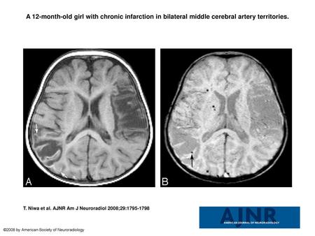 A 12-month-old girl with chronic infarction in bilateral middle cerebral artery territories. A 12-month-old girl with chronic infarction in bilateral middle.
