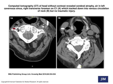 Computed tomography (CT) of head without contrast revealed cerebral atrophy, air in left cavernous sinus, right transverse foramen on C1 (A) which tracked.