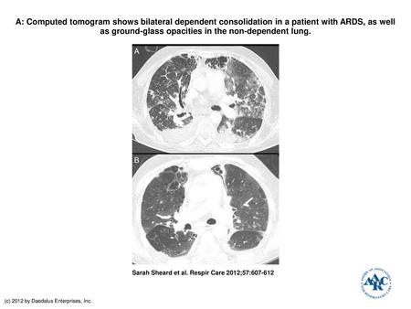 A: Computed tomogram shows bilateral dependent consolidation in a patient with ARDS, as well as ground-glass opacities in the non-dependent lung. A: Computed.
