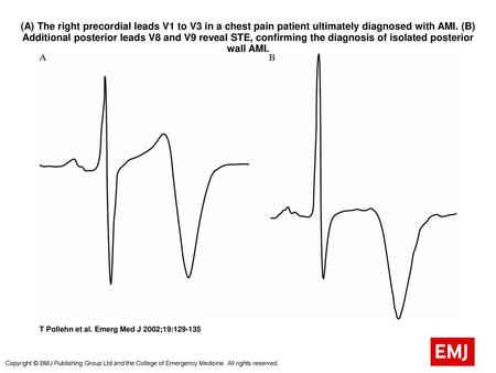 (A) The right precordial leads V1 to V3 in a chest pain patient ultimately diagnosed with AMI. (B) Additional posterior leads V8 and V9 reveal STE, confirming.