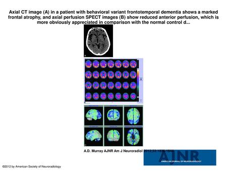 Axial CT image (A) in a patient with behavioral variant frontotemporal dementia shows a marked frontal atrophy, and axial perfusion SPECT images (B) show.