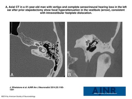 A, Axial CT in a 41-year-old man with vertigo and complete sensorineural hearing loss in the left ear after prior stapedectomy show focal hyperattenuation.