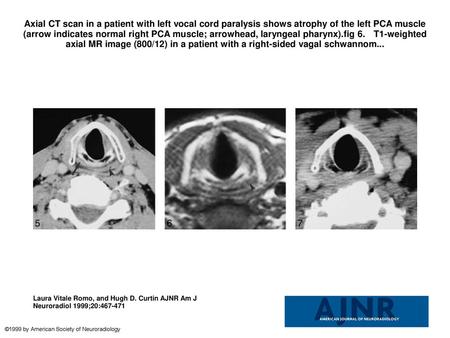Axial CT scan in a patient with left vocal cord paralysis shows atrophy of the left PCA muscle (arrow indicates normal right PCA muscle; arrowhead, laryngeal.