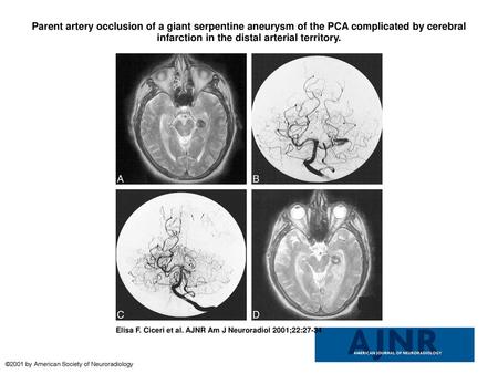 Parent artery occlusion of a giant serpentine aneurysm of the PCA complicated by cerebral infarction in the distal arterial territory. Parent artery occlusion.