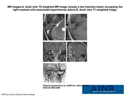 MR images.A, Axial view T2-weighted MR image reveals a low intensity lesion occupying the right mastoid with associated hyperintense debris.B, Axial view.