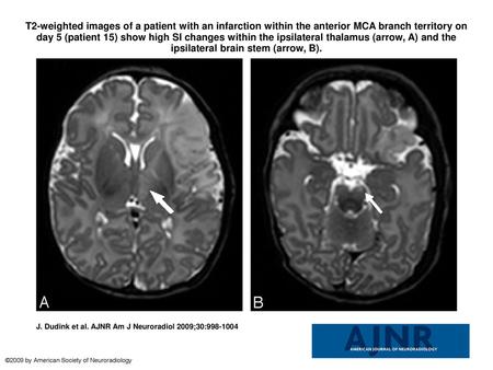 T2-weighted images of a patient with an infarction within the anterior MCA branch territory on day 5 (patient 15) show high SI changes within the ipsilateral.