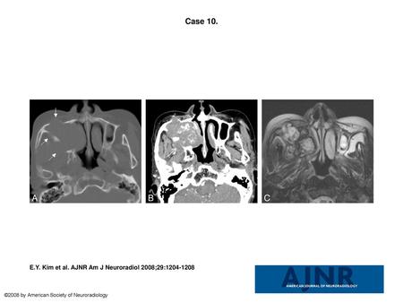 Case 10. Case 10. Organized hematoma of the maxillary sinus in a 76-year-old woman. A, Precontrast axial CT scan with bone window setting shows a large,