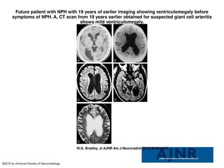 Future patient with NPH with 19 years of earlier imaging showing ventriculomegaly before symptoms of NPH. A, CT scan from 19 years earlier obtained for.