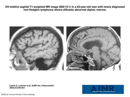 Off-midline sagittal T1-weighted MR image (600/12/1) in a 63-year-old man with newly diagnosed non-Hodgkin lymphoma shows diffusely abnormal diploic marrow.