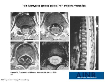 Radiculomyelitis causing bilateral AFP and urinary retention.