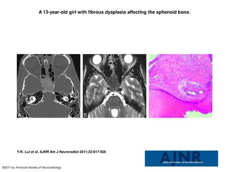 A 13-year-old girl with fibrous dysplasia affecting the sphenoid bone.