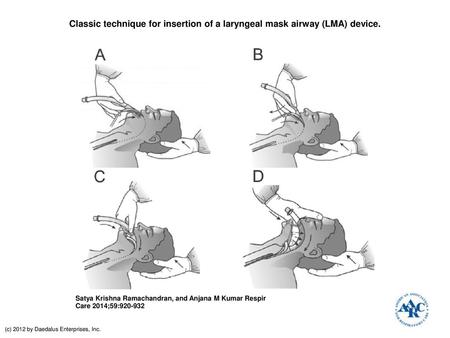 Classic technique for insertion of a laryngeal mask airway (LMA) device. Classic technique for insertion of a laryngeal mask airway (LMA) device. With.