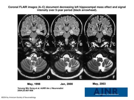 Coronal FLAIR images (A–C) document decreasing left hippocampal mass effect and signal intensity over 5-year period (black arrowhead). Coronal FLAIR images.