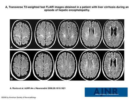 A, Transverse T2-weighted fast FLAIR images obtained in a patient with liver cirrhosis during an episode of hepatic encephalopathy. A, Transverse T2-weighted.