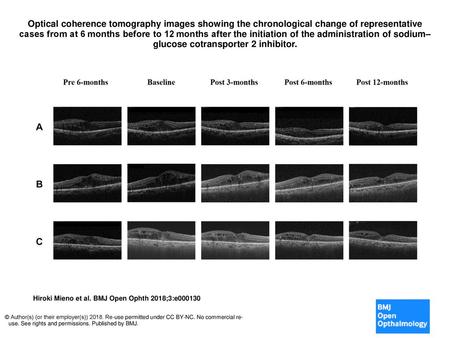 Optical coherence tomography images showing the chronological change of representative cases from at 6 months before to 12 months after the initiation.