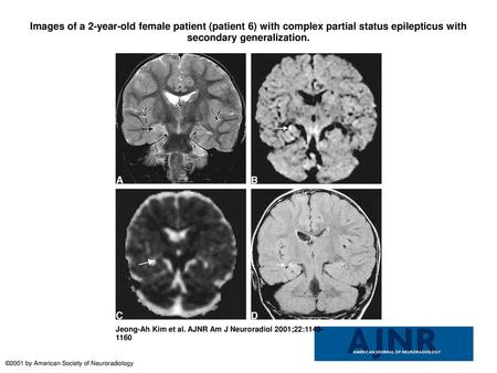 Images of a 2-year-old female patient (patient 6) with complex partial status epilepticus with secondary generalization. Images of a 2-year-old female.