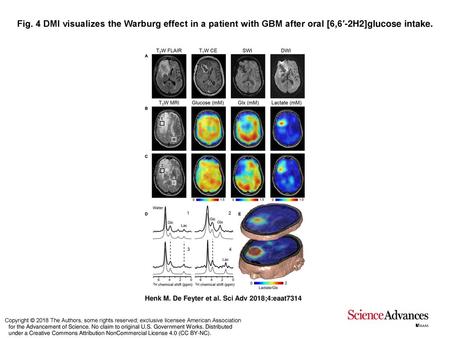 Fig. 4 DMI visualizes the Warburg effect in a patient with GBM after oral [6,6′-2H2]glucose intake. DMI visualizes the Warburg effect in a patient with.