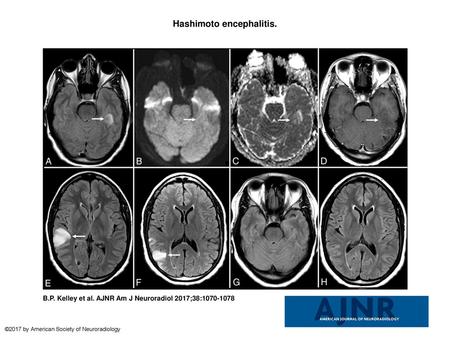 Hashimoto encephalitis.