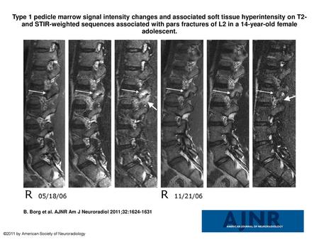 Type 1 pedicle marrow signal intensity changes and associated soft tissue hyperintensity on T2- and STIR-weighted sequences associated with pars fractures.