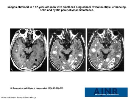 Images obtained in a 57-year-old-man with small-cell lung cancer reveal multiple, enhancing, solid and cystic parenchymal metastases. Images obtained in.