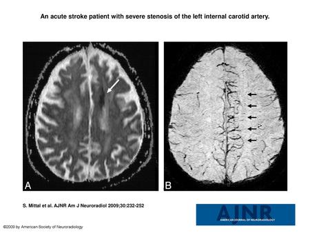 An acute stroke patient with severe stenosis of the left internal carotid artery. An acute stroke patient with severe stenosis of the left internal carotid.