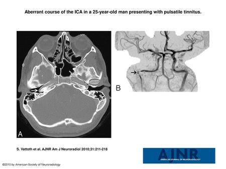 Aberrant course of the ICA in a 25-year-old man presenting with pulsatile tinnitus. Aberrant course of the ICA in a 25-year-old man presenting with pulsatile.