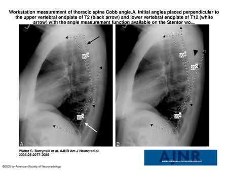 Workstation measurement of thoracic spine Cobb angle