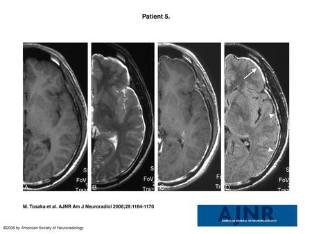 Patient 5. Patient 5. Initial axial, half cut, and magnified MR images of a 39-year-old man with spontaneous intracranial hypotension who presented with.