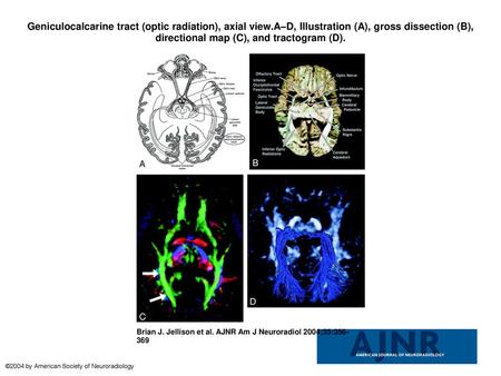 Geniculocalcarine tract (optic radiation), axial view