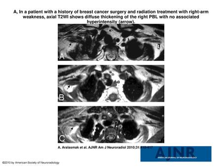 A, In a patient with a history of breast cancer surgery and radiation treatment with right-arm weakness, axial T2WI shows diffuse thickening of the right.