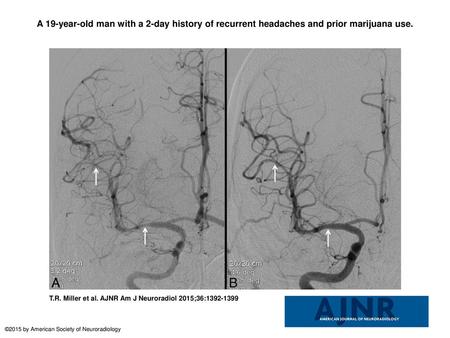 A 19-year-old man with a 2-day history of recurrent headaches and prior marijuana use. A 19-year-old man with a 2-day history of recurrent headaches and.