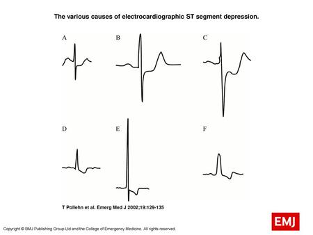 The various causes of electrocardiographic ST segment depression.