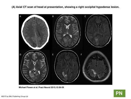 (A) Axial CT scan of head at presentation, showing a right occipital hypodense lesion. (A) Axial CT scan of head at presentation, showing a right occipital.