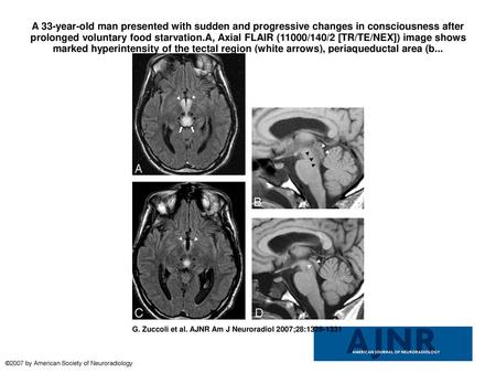 A 33-year-old man presented with sudden and progressive changes in consciousness after prolonged voluntary food starvation.A, Axial FLAIR (11000/140/2.