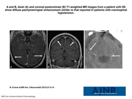A and B, Axial (A) and coronal postcontrast (B) T1-weighted MR images from a patient with SS show diffuse pachymeningeal enhancement similar to that reported.