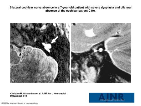 Bilateral cochlear nerve absence in a 7-year-old patient with severe dysplasia and bilateral absence of the cochlea (patient C10). Bilateral cochlear nerve.