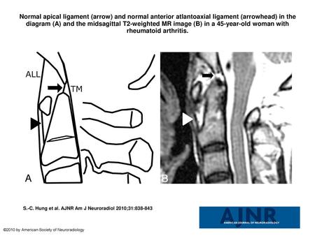 Normal apical ligament (arrow) and normal anterior atlantoaxial ligament (arrowhead) in the diagram (A) and the midsagittal T2-weighted MR image (B) in.