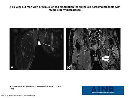 A 50-year-old man with previous left leg amputation for epitheloid sarcoma presents with multiple bony metastases. A 50-year-old man with previous left.