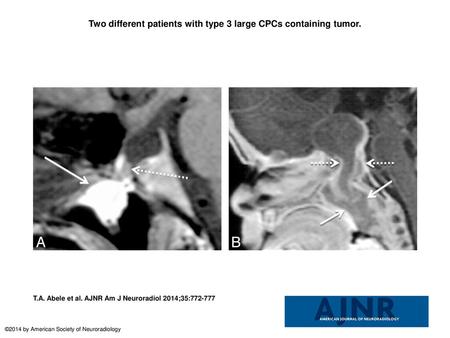 Two different patients with type 3 large CPCs containing tumor.